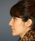 Feel Beautiful - Rhinoplasty 225 - Before Photo